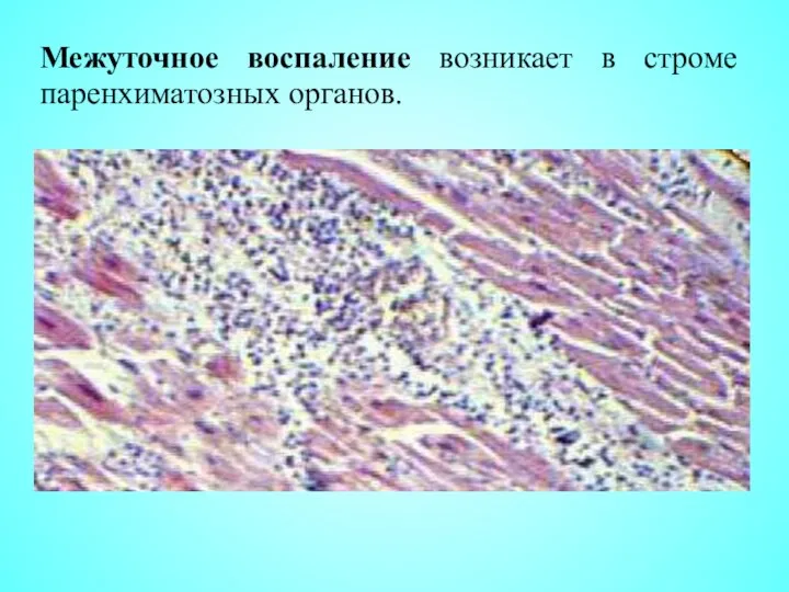 Межуточное воспаление возникает в строме паренхиматозных органов.