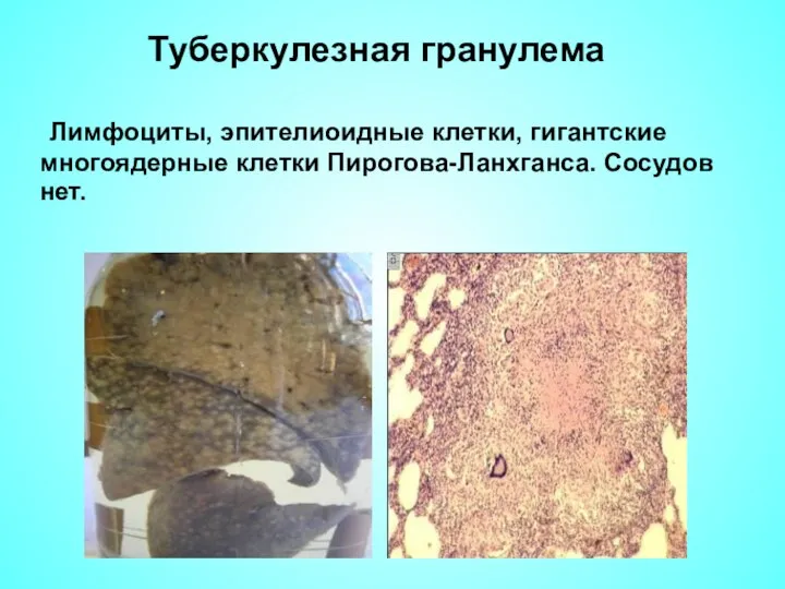 Туберкулезная гранулема Лимфоциты, эпителиоидные клетки, гигантские многоядерные клетки Пирогова-Ланхганса. Сосудов нет.