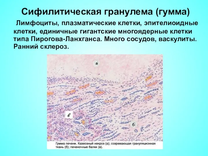 Сифилитическая гранулема (гумма) Лимфоциты, плазматические клетки, эпителиоидные клетки, единичные гигантские многоядерные клетки