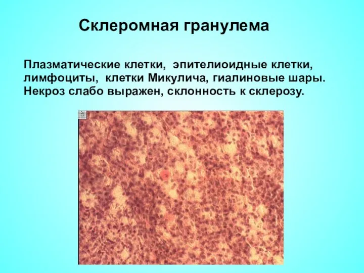 Склеромная гранулема Плазматические клетки, эпителиоидные клетки, лимфоциты, клетки Микулича, гиалиновые шары. Некроз