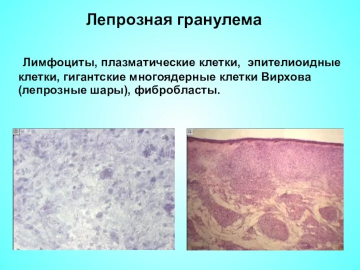 Лепрозная гранулема Лимфоциты, плазматические клетки, эпителиоидные клетки, гигантские многоядерные клетки Вирхова (лепрозные шары), фибробласты.