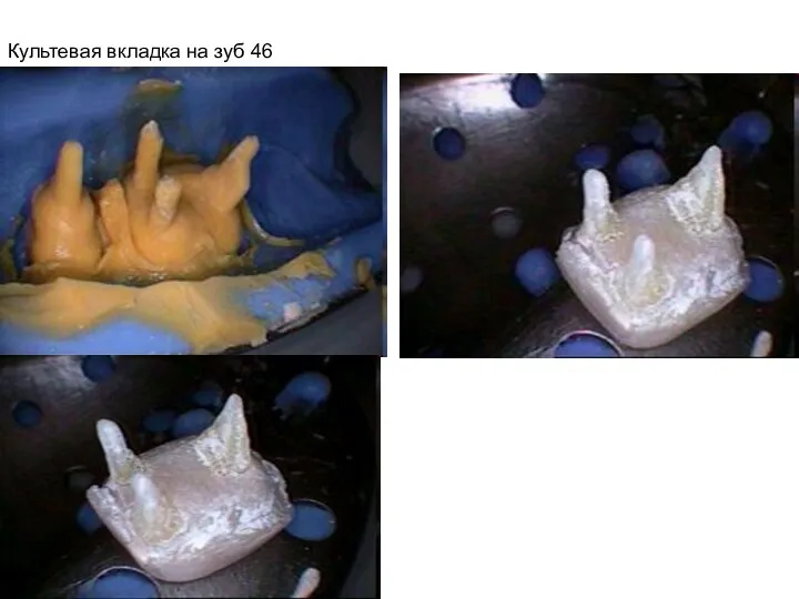 Культевая вкладка на зуб 46