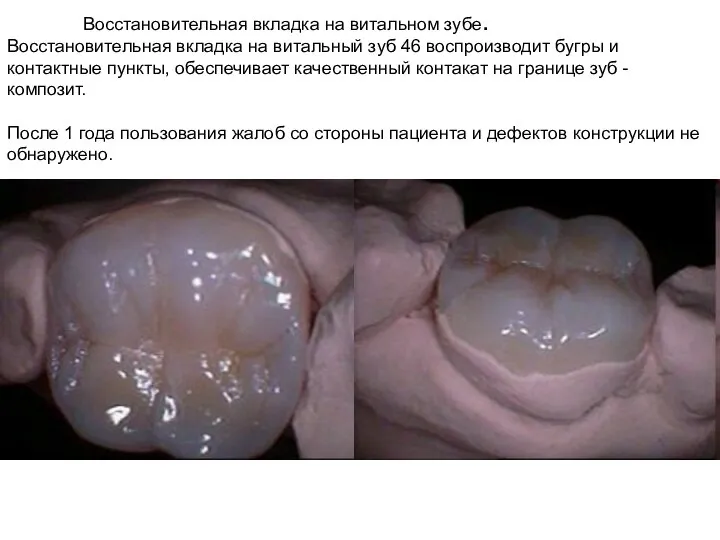 Восстановительная вкладка на витальном зубе. Восстановительная вкладка на витальный зуб 46 воспроизводит