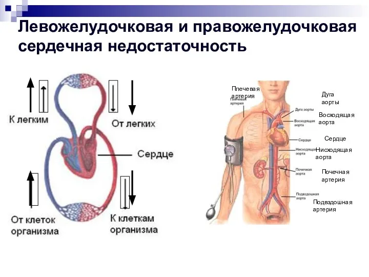 Левожелудочковая и правожелудочковая сердечная недостаточность Почечная артерия Подвздошная артерия Нисходящая аорта Восходящая