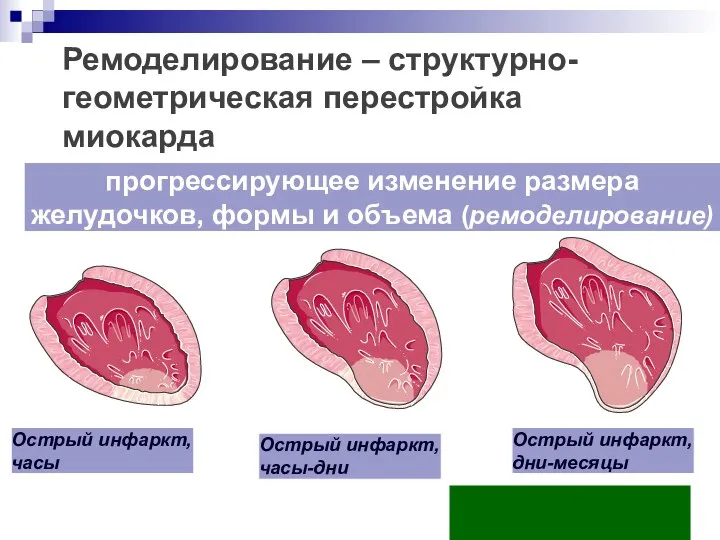 прогрессирующее изменение размера желудочков, формы и объема (ремоделирование) Ремоделирование – структурно-геометрическая перестройка