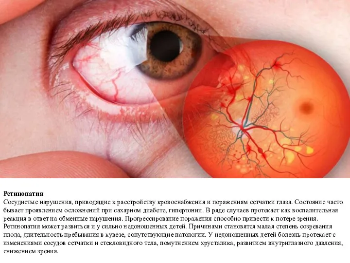 Ретинопатия Сосудистые нарушения, приводящие к расстройству кровоснабжения и поражениям сетчатки глаза. Состояние