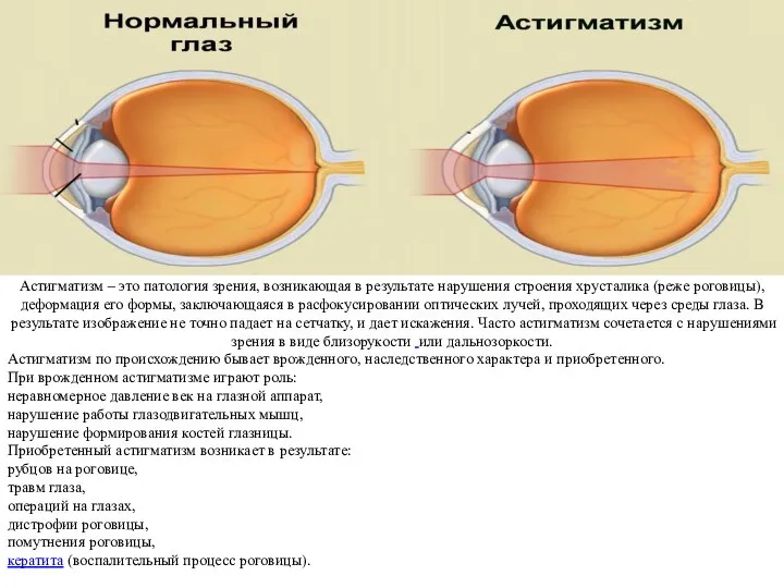 Астигматизм – это патология зрения, возникающая в результате нарушения строения хрусталика (реже