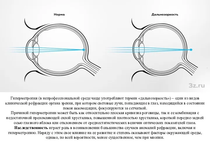 Гиперметропия (в непрофессиональной среде чаще употребляют термин «дальнозоркость») – один из видов
