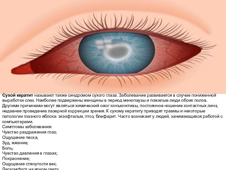Сухой кератит называют также синдромом сухого глаза. Заболевание развивается в случае пониженной