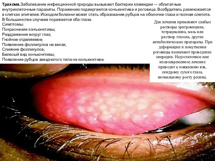 Трахома.Заболевание инфекционной природы вызывают бактерии хламидии — облигатные внутриклеточные паразиты. Поражению подвергаются