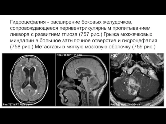 Гидроцефалия - расширение боковых желудочков, сопровождающееся перивентрикулярным пропитыванием ликвора с развитием глиоза