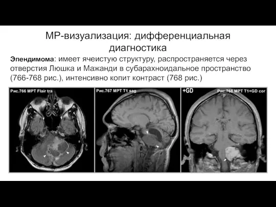 МР-визуализация: дифференциальная диагностика Эпендимома: имеет ячеистую структуру, распространяется через отверстия Люшка и