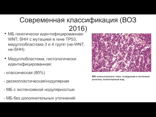 Современная классификация (ВОЗ 2016) МБ генетически идентифицированная: WNT, SHH с мутацией в