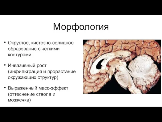 Морфология Округлое, кистозно-солидное образование с четкими контурами Инвазивный рост (инфильтрация и прорастание