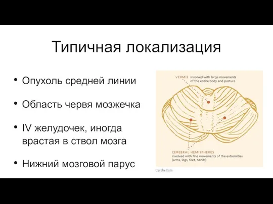 Типичная локализация Опухоль средней линии Область червя мозжечка IV желудочек, иногда врастая