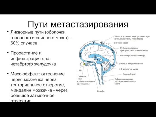 Пути метастазирования Ликворные пути (оболочки головного и спинного мозга) - 60% случаев