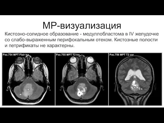 МР-визуализация Кистозно-солидное образование - медуллобластома в IV желудочке со слабо-выраженным перифокальным отеком.