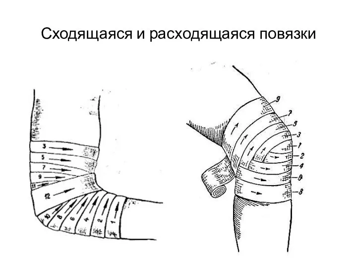 Сходящаяся и расходящаяся повязки