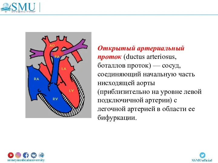 Открытый артериальный проток (ductus arteriosus, боталлов проток) — сосуд, соединяющий начальную часть