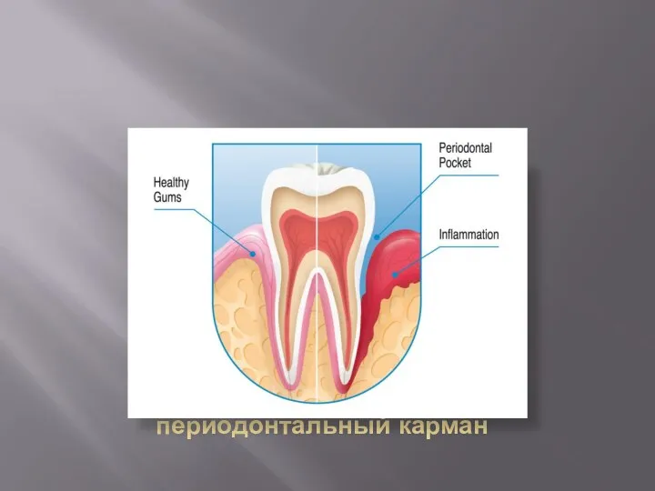 Образование периодонтальный карман