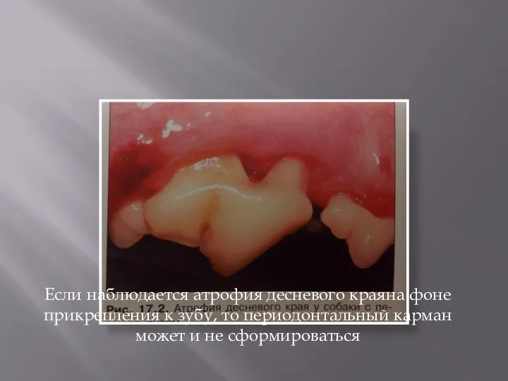 Если наблюдается атрофия десневого краяна фоне прикрепления к зубу, то периодонтальный карман может и не сформироваться