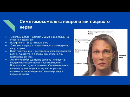 Симптомокомплекс невропатии лицевого нерва Симптом Белла – слабость мимических мышц на стороне