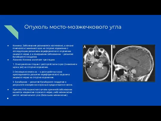 Опухоль мосто-мозжечкового угла Клиника. Заболевание развивается постепенно, в начале отмечается снижение слуха