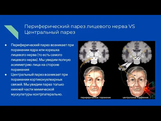 Периферический парез лицевого нерва VS Центральный парез Периферический парез возникает при поражении