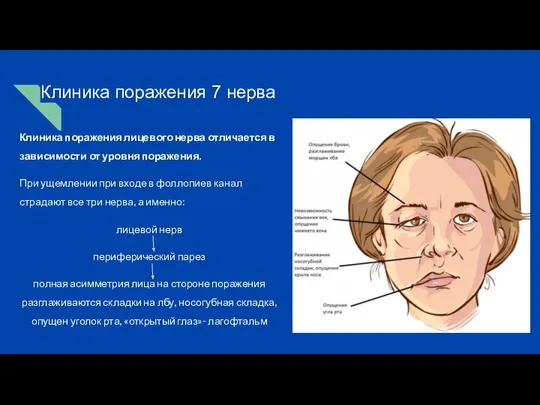 Клиника поражения 7 нерва Клиника поражения лицевого нерва отличается в зависимости от