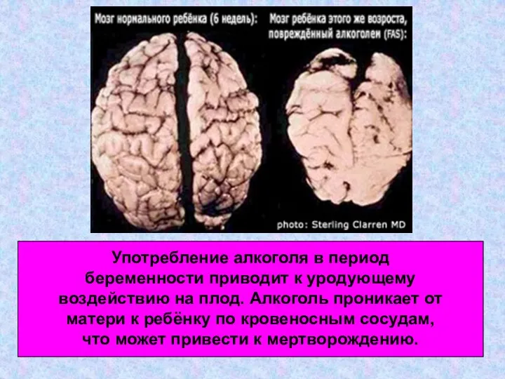 Употребление алкоголя в период беременности приводит к уродующему воздействию на плод. Алкоголь