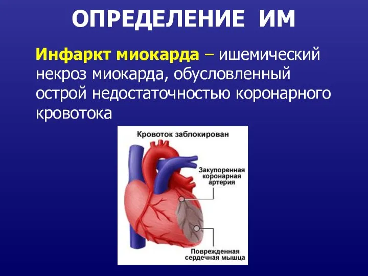 ОПРЕДЕЛЕНИЕ ИМ Инфаркт миокарда – ишемический некроз миокарда, обусловленный острой недостаточностью коронарного кровотока