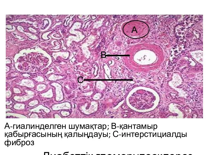 Диабеттік гломерулосклероз А-гиалинделген шумақтар; В-қантамыр қабырғасының қалыңдауы; С-интерстициалды фиброз А В С