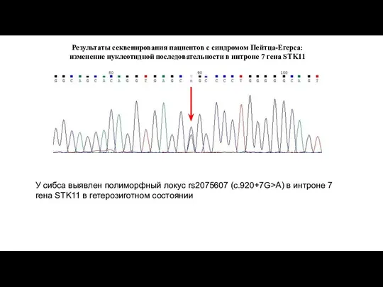 Результаты секвенирования пациентов с синдромом Пейтца-Егерса: изменение нуклеотидной последовательности в интроне 7