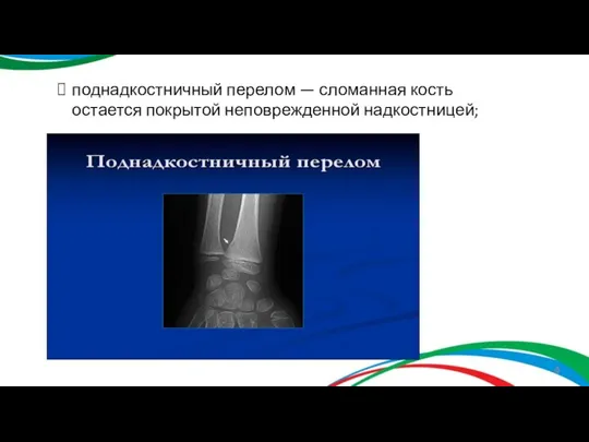 поднадкостничный перелом — сломанная кость остается покрытой неповрежденной надкостницей;