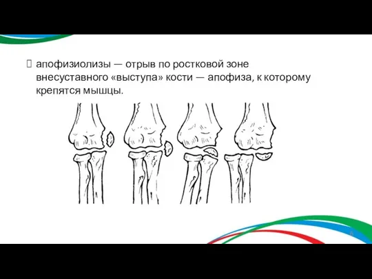 апофизиолизы — отрыв по ростковой зоне внесуставного «выступа» кости — апофиза, к которому крепятся мышцы.