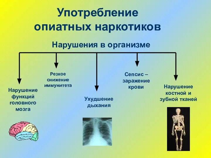 Употребление опиатных наркотиков Нарушение функций головного мозга Нарушение костной и зубной тканей