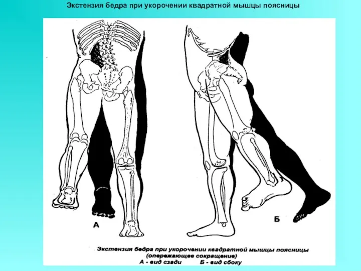Экстензия бедра при укорочении квадратной мышцы поясницы