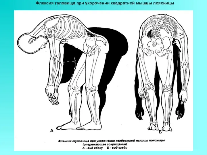 Флексия туловища при укорочении квадратной мышцы поясницы