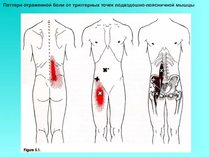 Паттерн отраженной боли от триггерных точек подвздошно-поясничной мышцы