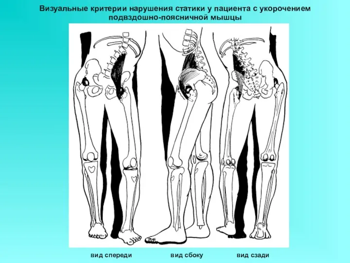 Визуальные критерии нарушения статики у пациента с укорочением подвздошно-поясничной мышцы вид спереди вид сбоку вид сзади