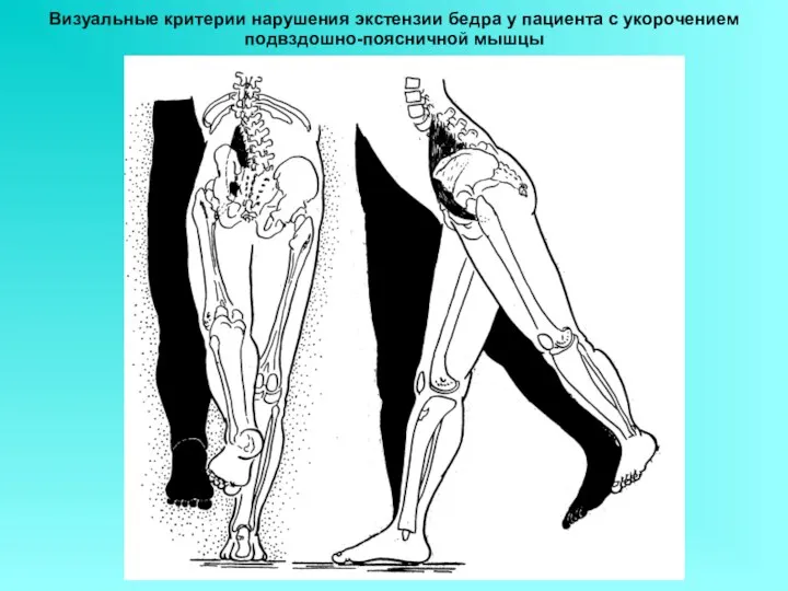 Визуальные критерии нарушения экстензии бедра у пациента с укорочением подвздошно-поясничной мышцы