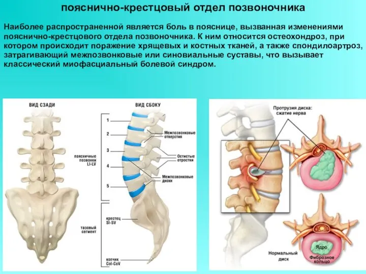 Наиболее распространенной является боль в пояснице, вызванная изменениями пояснично-крестцового отдела позвоночника. К