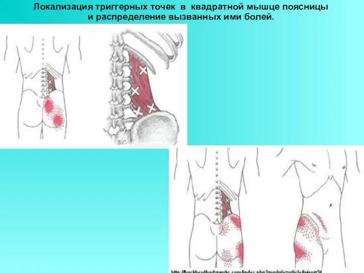 Локализация триггерных точек в квадратной мышце поясницы и распределение вызванных ими болей.