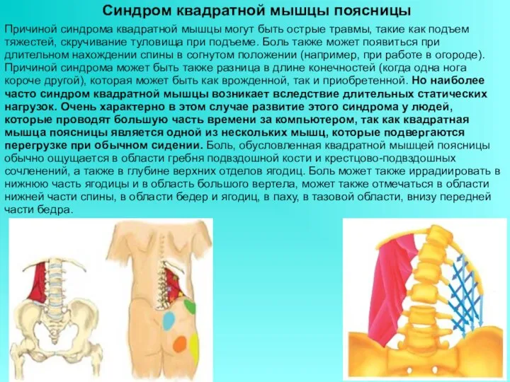 Синдром квадратной мышцы поясницы Причиной синдрома квадратной мышцы могут быть острые травмы,