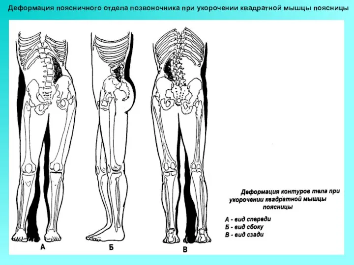 Деформация поясничного отдела позвоночника при укорочении квадратной мышцы поясницы