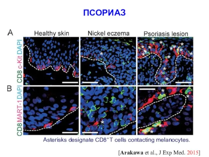 ПСОРИАЗ [Arakawa et al., J Exp Med. 2015] Asterisks designate CD8+ T cells contacting melanocytes.