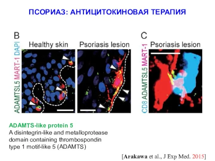 ПСОРИАЗ: АНТИЦИТОКИНОВАЯ ТЕРАПИЯ [Arakawa et al., J Exp Med. 2015] ADAMTS-like protein