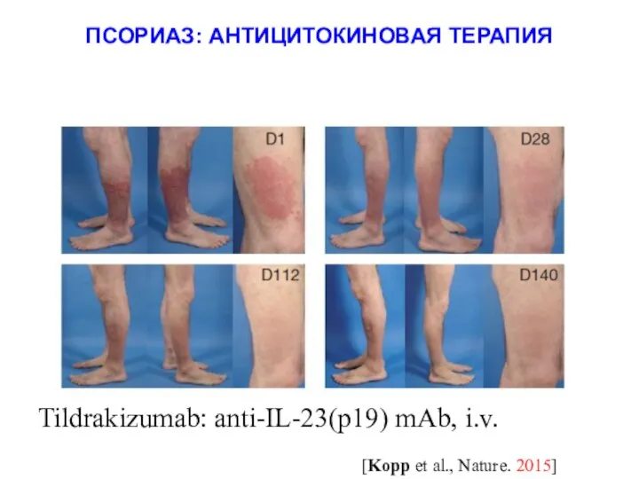 Tildrakizumab: anti-IL-23(p19) mAb, i.v. [Kopp et al., Nature. 2015] ПСОРИАЗ: АНТИЦИТОКИНОВАЯ ТЕРАПИЯ