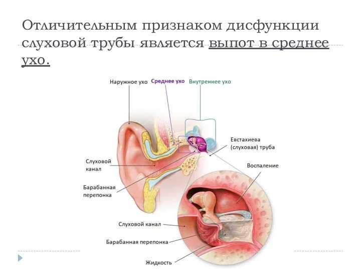 Отличительным признаком дисфункции слуховой трубы является выпот в среднее ухо.