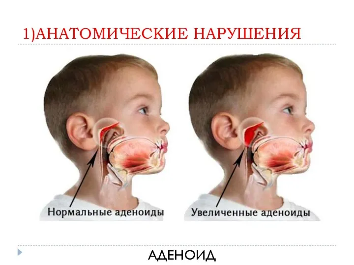 1)АНАТОМИЧЕСКИЕ НАРУШЕНИЯ АДЕНОИДЫ